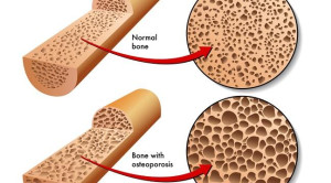 Suplementasi Kalsium dan Vitamin D Terbukti Tidak Menurunkan Insidensi Fraktur Pada Lansia