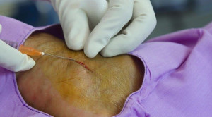 Kombinasi Lidokain-Bikarbonat Untuk Mengurangi Nyeri Prosedural Saat Anestesi Lokal