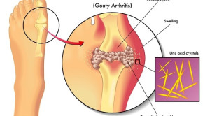 Terapi Dosis Titrasi Lebih Baik Dibandingkan Dosis Tetap untuk Gout