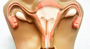 Efek Samping Copper IUD – Apakah Berkurang Seiring Waktu?