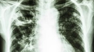 Diagnosis Lesi Kavitas pada Rontgen Toraks