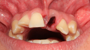 Upaya Mendapatkan Hasil Maksimal pada Gigi Avulsi