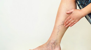 Efikasi Flavonoid Sebagai Terapi Alternatif Varises Tungkai Bawah