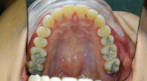 Toksisitas Restorasi Dental Amalgam