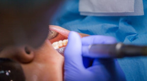 Manajemen Pasien Bedah Dental yang Mengonsumsi Novel Oral Anticoagulants (NOAC)