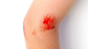 Perlu Tidaknya Antibiotik Topikal untuk Luka Tanpa Komplikasi