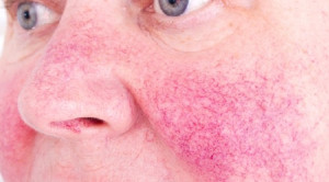 Pemilihan Bentuk Sediaan Antibiotik untuk Penanganan Rosacea