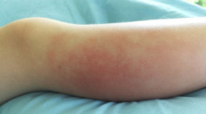 Red Flag Keluhan Kaki Merah