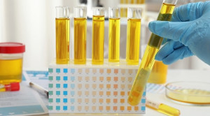 Urinalisis vs Kultur Urine untuk Mendiagnosis Infeksi Saluran Kemih Anak