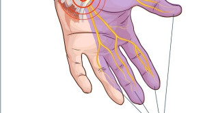 Injeksi Kortikosteroid dengan Panduan USG untuk Terapi Carpal Tunnel Syndrome