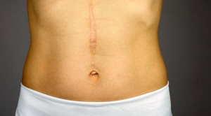 Upaya Menghasilkan Parut Luka yang Optimal