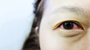 Red Flag Mata Merah Disertai Nyeri