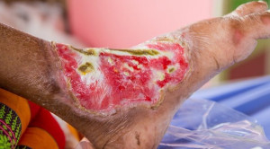 Prinsip Penatalaksanaan Luka Kronik