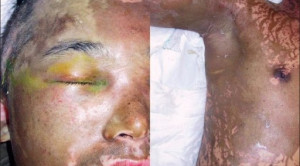 Pedoman Klinis Penanganan Luka Bakar Kimia