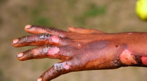 Pertolongan Pertama Prehospital Luka Bakar