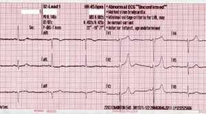 Interpretasi EKG secara Digital dapat Menyebabkan Kesalahan Medis