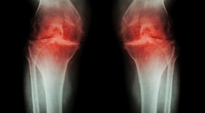 Glukosamin dan Kondroitin dalam Penatalaksanaan Osteoarthritis