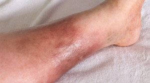 Manfaat Statin pada Deep Vein Thrombosis (DVT)
