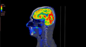 Peranan Pencitraan Kedokteran Nuklir pada Demensia Alzheimer