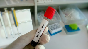 Manfaat Pemeriksaan Anti-Cyclic Citrullinated Peptide dan Rheumatoid Factor pada Rheumatoid Arthritis