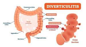 Kolonoskopi pada Divertikulitis Akut
