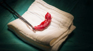 Apendektomi Laparoskopik VS Apendektomi Terbuka pada Appendicitis Akut