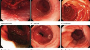 Budesonide Suspensi Topikal sebagai Pilihan Terapi Esofagitis Eosinofilik