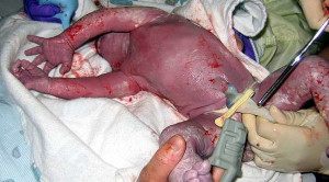 Dampak Penjepitan Tali Pusat Tertunda terhadap Neurokognitif Anak – Telaah Jurnal Alomedika