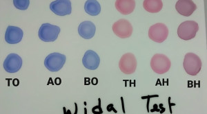 Tes Widal Sebagai Pemeriksaan Awal Demam Tifoid: Masihkan Bermanfaat?