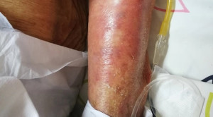 Siklosporin untuk Sindroma Stevens Johnson (SJS) dan Toxic Epidermal Necrolysis (TEN) : Sebuah Modalitas Baru