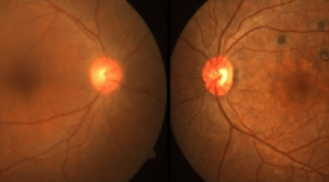 Membedakan Penyebab Emergensi dan Nonemergensi dari Flashes dan Floaters