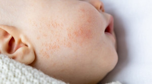 Pengaruh Sectio Caesarea Terhadap Prevalensi Alergi Anak