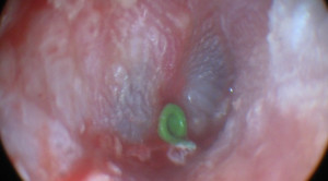 Perlukah Melakukan Timpanostomi Pada Otitis Media Akut Berulang