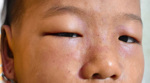 Pemberian Profilaksis Antikoagulan pada Pasien Sindrom Nefrotik