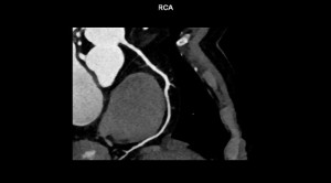 Penggunaan Coronary CT Angiography pada Angina Pektoris Stabil