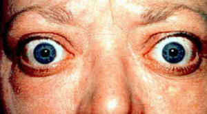 Terapi Radioiodine Vs Obat Antitiroid untuk Penyakit Graves - Telaah Jurnal