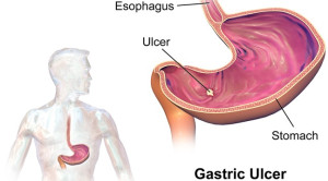Pertimbangan Penggunaan Penghambat Pompa Proton pada Pasien yang Mendapat Antikoagulan Dan/Atau Antiplatelet – Telaah Jurnal
