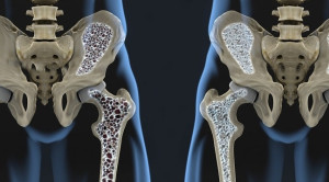 Teriparatide vs Risedronate untuk Osteoporosis Pencegahan Dan Terapi Osteoporosis Akibat Glukokortikoid – Telaah Jurnal Alomedika