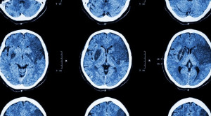 Cilostazol Sebagai Terapi Preventif Primer Stroke dan Pencegahan Re-Stenting Pasca PCI