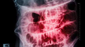 Terapi Operatif Vs Non-Operatif untuk Adhesive Small Bowel Obstruction