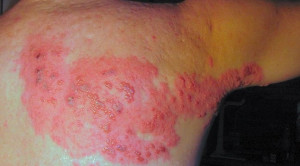 Opsi Analgesik untuk Nyeri Herpes