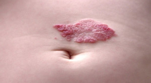 Propranolol VS Captopril untuk Penatalaksanaan Hemangioma Infantil