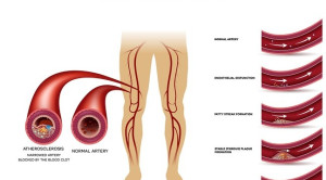 Peningkatan Risiko Penyakit Arteri Perifer pada Infeksi HIV