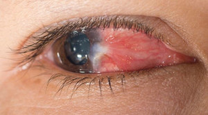 Pterigium Sebagai Prediktor Kejadian Melanoma Kutaneus