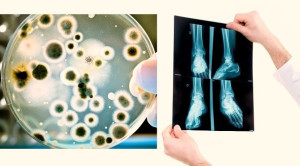 Pemeriksaan Imaging dan Kultur Darah Tidak Direkomendasikan pada Selulitis