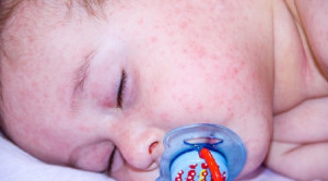 Efektivitas Formula Asam Amino untuk Alergi Susu Sapi Berat