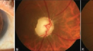 Glaukoma Sekunder Pascaoperasi Katarak Kongenital