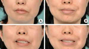 Membedakan Paralisis Nervus Fasialis Sentral dan Perifer