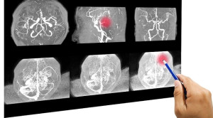 Penggunaan Antikoagulan pada Stroke Iskemik Akut