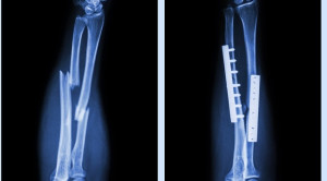 Plat Logam Pasca Fraktur: Perlu Diangkat Atau Tidak